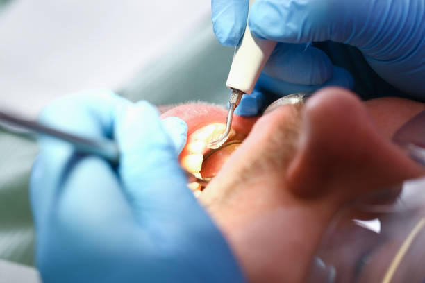 Best Emergency Treatment for Dental Infections or Abscesses in Horseheads North, NY